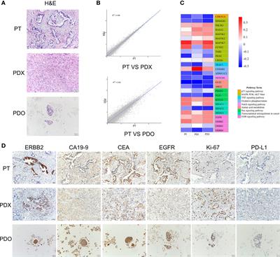 Screening of an individualized treatment strategy for an advanced gallbladder cancer using patient-derived tumor xenograft and organoid models